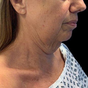 necklift-before